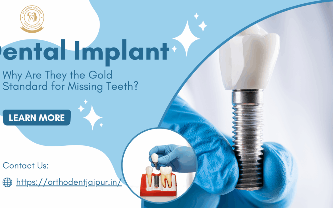 What Are Dental Implants and Why Are They the Gold Standard for Missing Teeth?