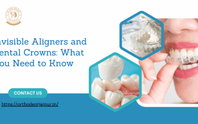 Invisible Aligners and Dental Crowns: What You Need to Know