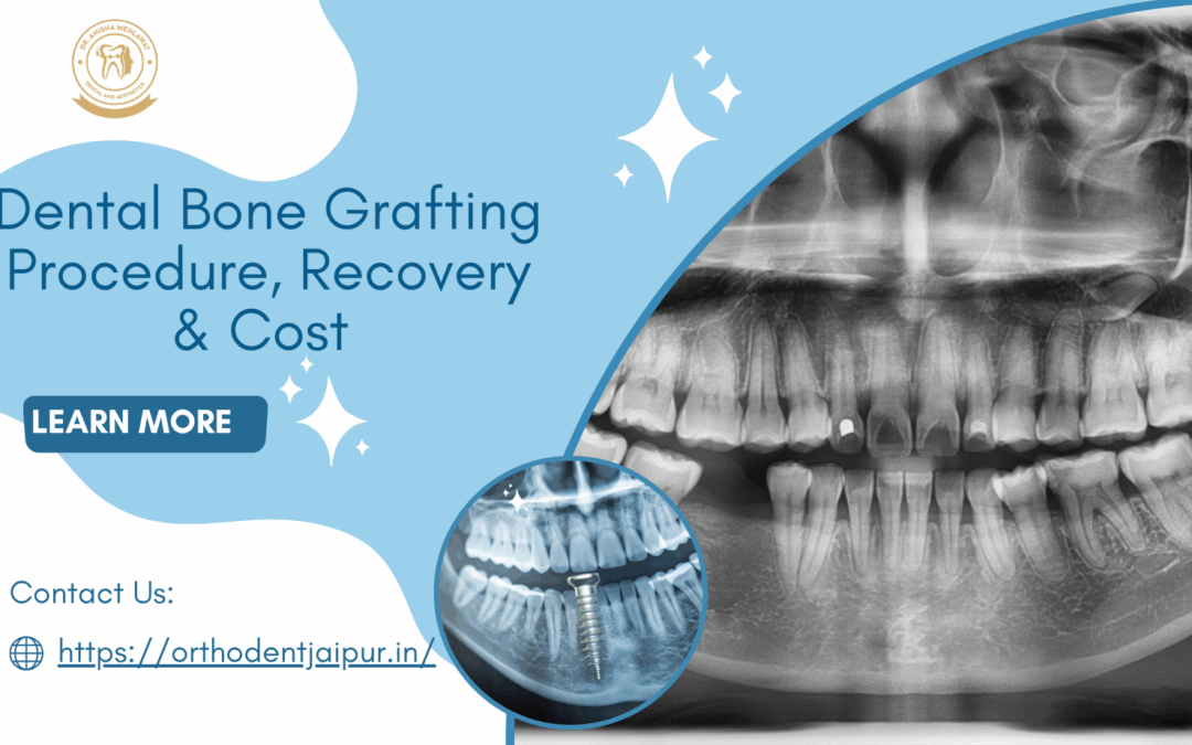 Dental Bone Grafting in Jaipur: Procedure, Recovery & Cost — Insights from Dr. Anisha Mehlawat