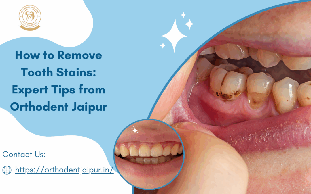 How to Remove Tooth Stains: Expert Tips from Orthodent Dental Care Jaipur